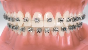 Breketai - nenuimami ortodontiniai aparatai
